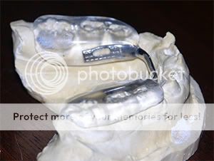 Posterior Bite plane Posterior Bite plane